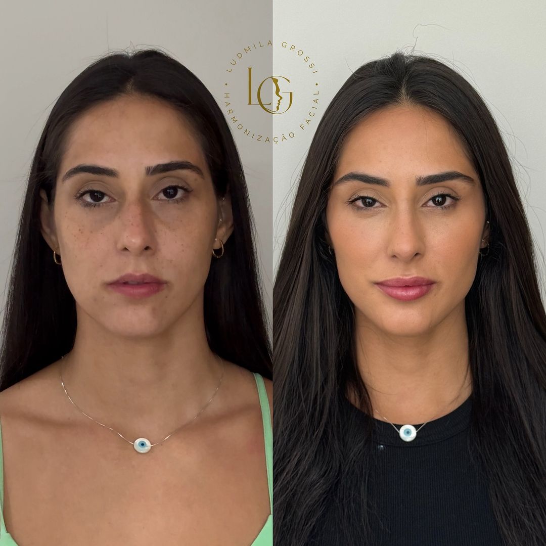 Harmonização Facial - Dra Ludmila Grossi Resultado (13)