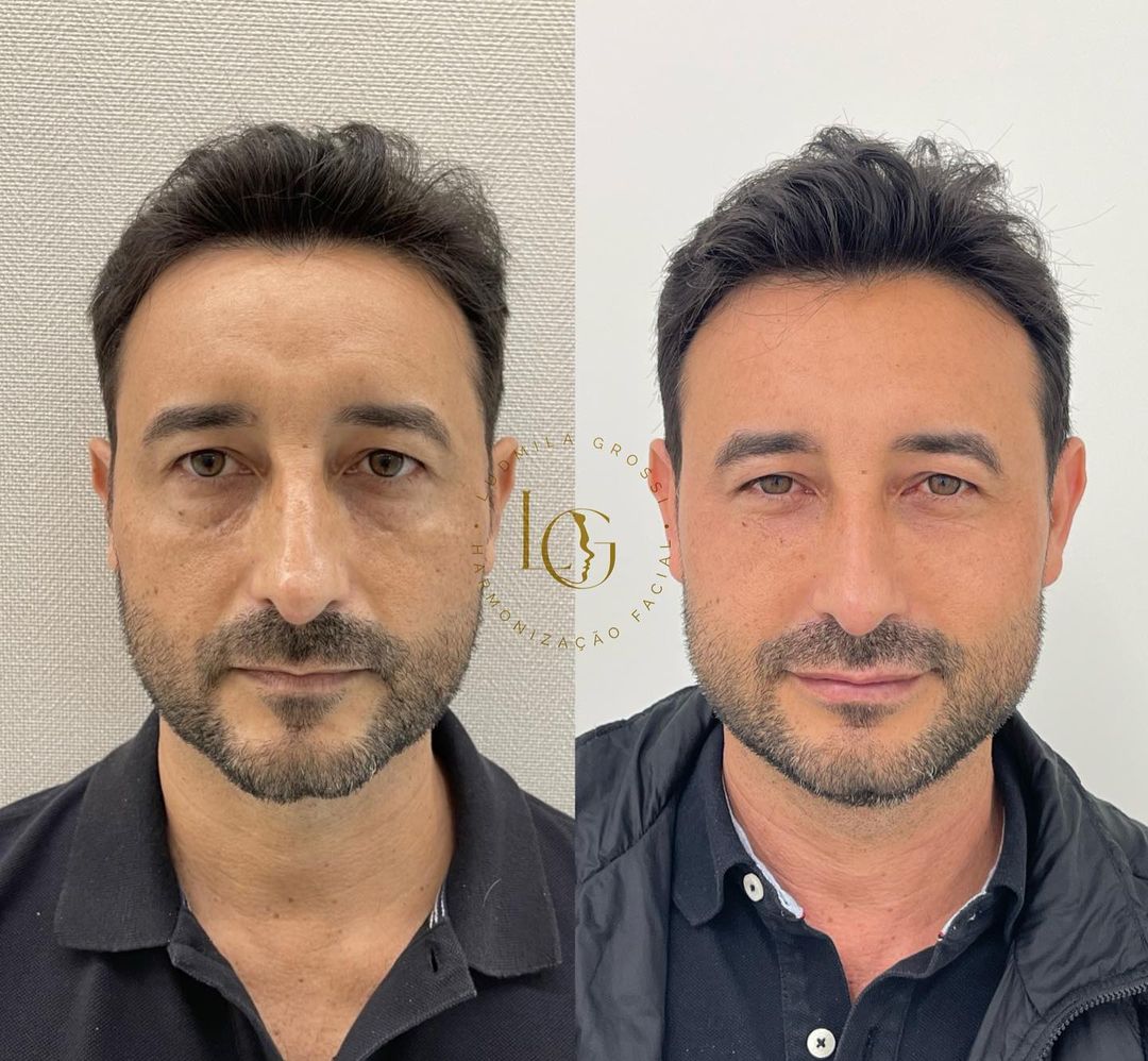 Harmonização Facial - Dra Ludmila Grossi Resultado (14)